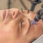 Microneedling Behandlung
