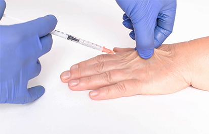 lipofilling an der hand