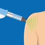 stosswellentherapie leipzig schulter arm