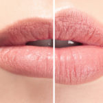 lippenbehandlung leipzig vorher nachher