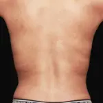 Rückansicht des Rückens einer 33-jährigen Frau nach einer Fettabsaugung mit Renuvion-Behandlung, mit gestraffter Haut und definierten Konturen, vor schwarzem Hintergrund.